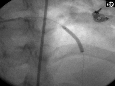 angioplastie